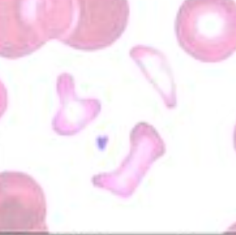 <p>red cell fragments; due to mechanical injury</p>