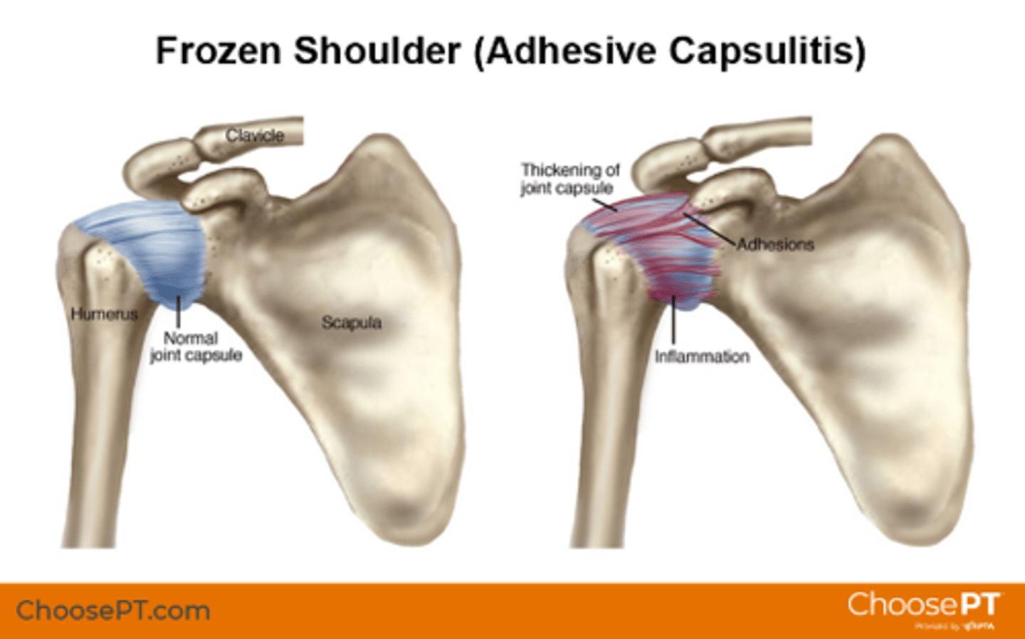 <p>Conservative management</p><p>•Self limiting: 1-2 years</p><p>•Physical therapy 3-6 months</p><p>•NSAIDS vs. Steroids</p><p>•Cortisone injection</p><p>Operative management</p><p>•Manipulation under anesthesia</p><p>•Arthroscopic capsular release</p>