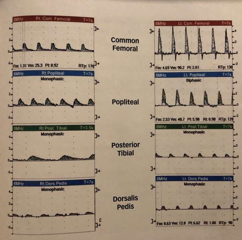 <ol><li><p>Where is the <em>most significant</em> arterial disease of the left extremity? </p></li><li><p>Explain why.</p></li><li><p>What is the name of the diseased area based on location?</p></li></ol><p></p>