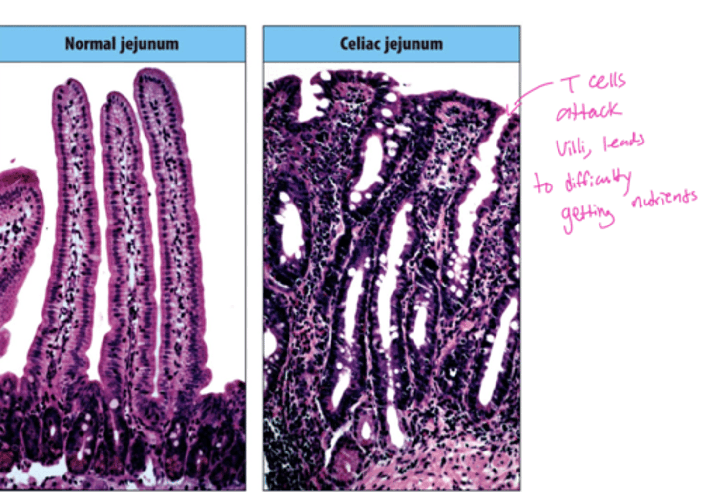 <p>A: Th1-mediated immune response.</p>