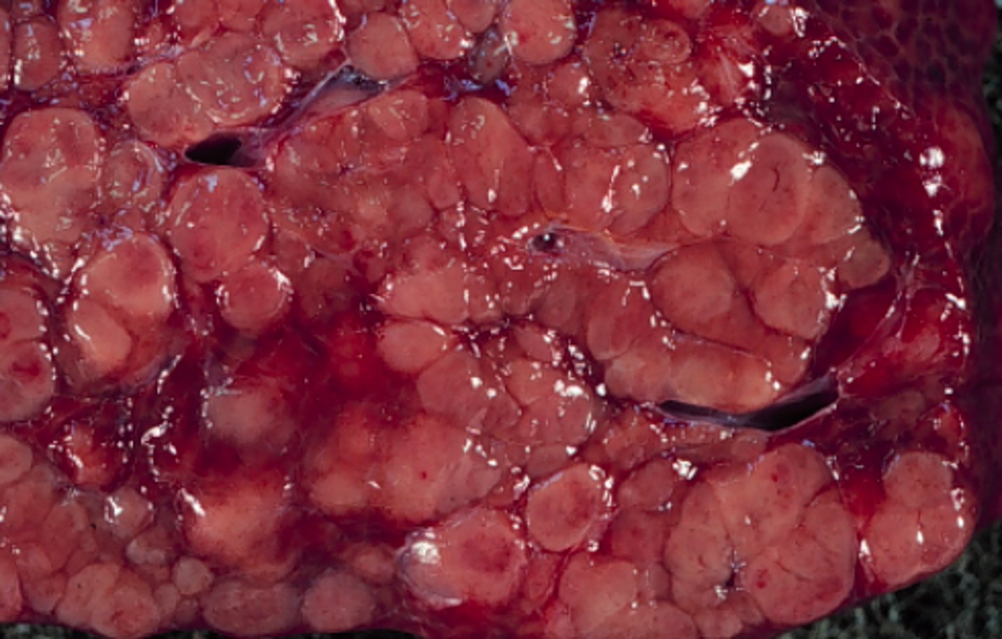 <p>Lever fra svin, hvad er den patoanatomiske diagnose?</p>