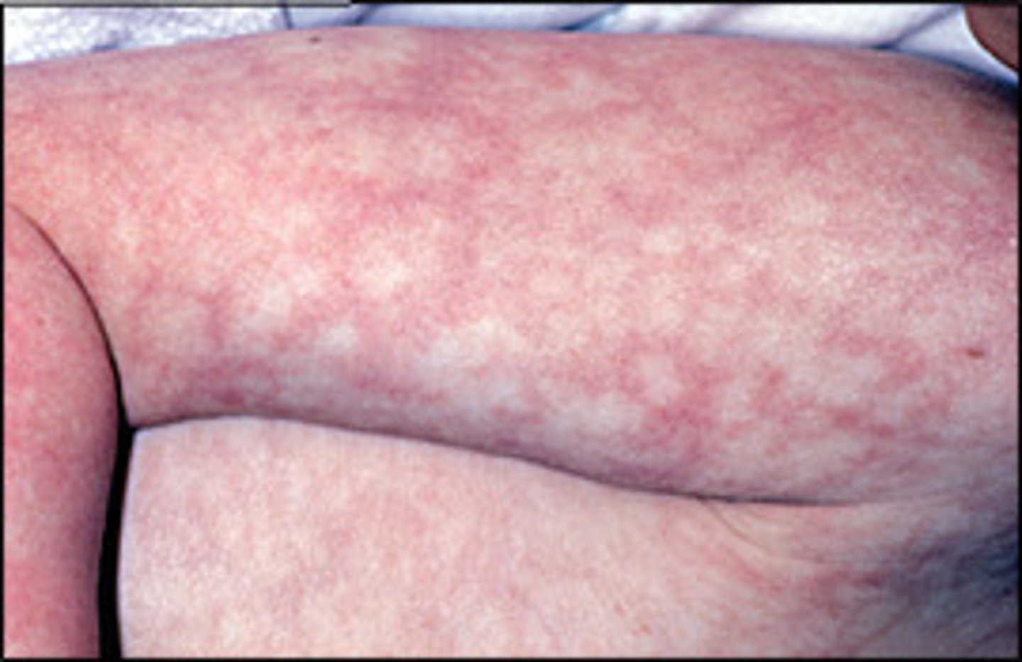 <p>common to see, due to cold - will disappear with warmth</p>