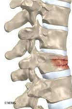 <p>occurs in vertebrae- extreme stresses</p>