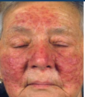 <p>COMMON DISORDERS SEEN WITH AGING</p><ul><li><p><span style="color: red;">appear as rashes or inflammation </span>that is either localized to certain areas of the body or generalized. </p></li><li><p><mark data-color="red" style="background-color: red; color: inherit;">Lesions are symmetrical</mark> and more severe in the periorbital region</p></li></ul><p></p>