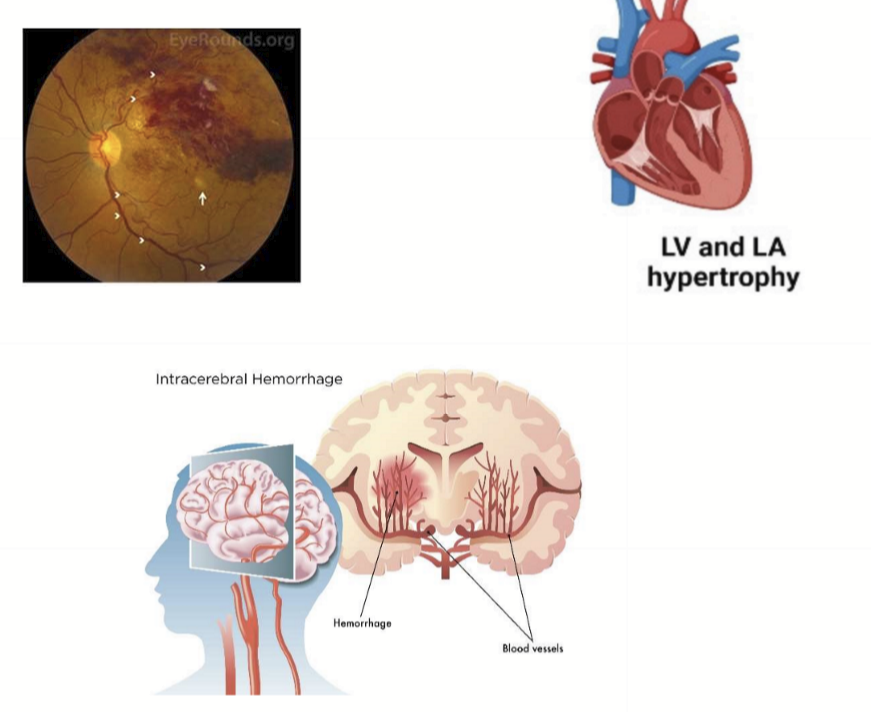 <ul><li><p>BRVO/CRVO: vision loss</p></li><li><p>CVA: hemorrhagic stroke</p></li><li><p>Heart: Hypertensive heart disease → CHF</p></li><li><p>Vascular issues from arteriosclerosis</p></li><li><p>Death</p></li></ul><p></p>