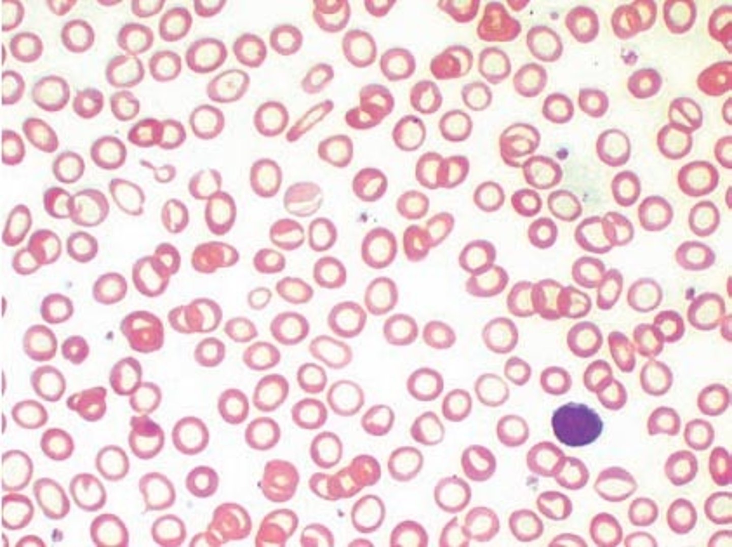 <p>- low hemoglobin per cell, likely due to deficiencies in vitamin B6, protein, or iron necessary to make RBCs</p>