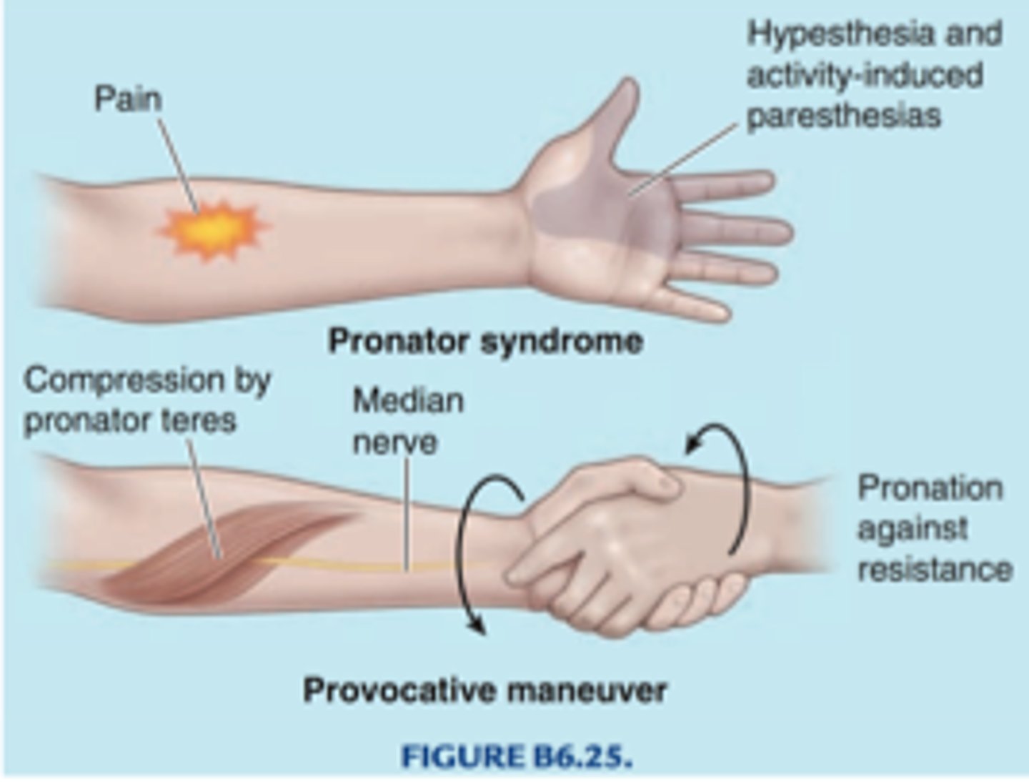 <p>identifies median nerve entrapment</p>