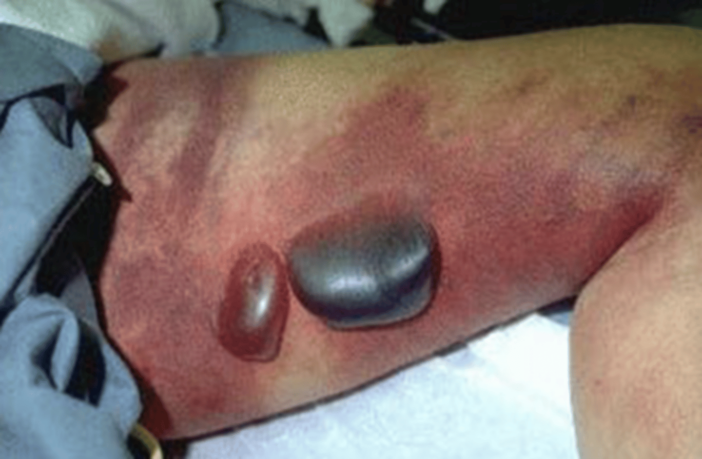 <p>grossly:</p><p>dark red-black</p><p>gas bubbles and fluid</p><p>microscopically:</p><p>coagulative necrosis</p><p>serohemorrhagic exudate</p><p>gas bubbles</p>