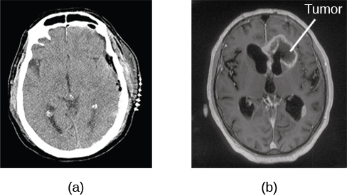 <p><span>taking a number of x-rays of a particular section of a person’s body or brain, passing them through tissues of different densities at different rates, allowing a computer to construct an overall image of the area of the body being scanned; often used to determine whether someone has a tumor, or significant brain atrophy.</span></p>