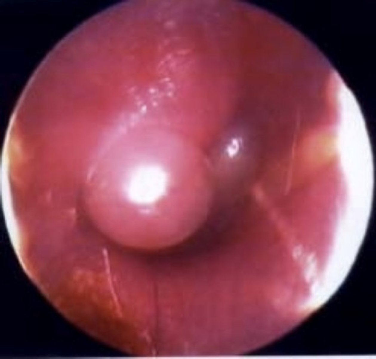 <p>painful hemorrhagic vesicles on TM</p>