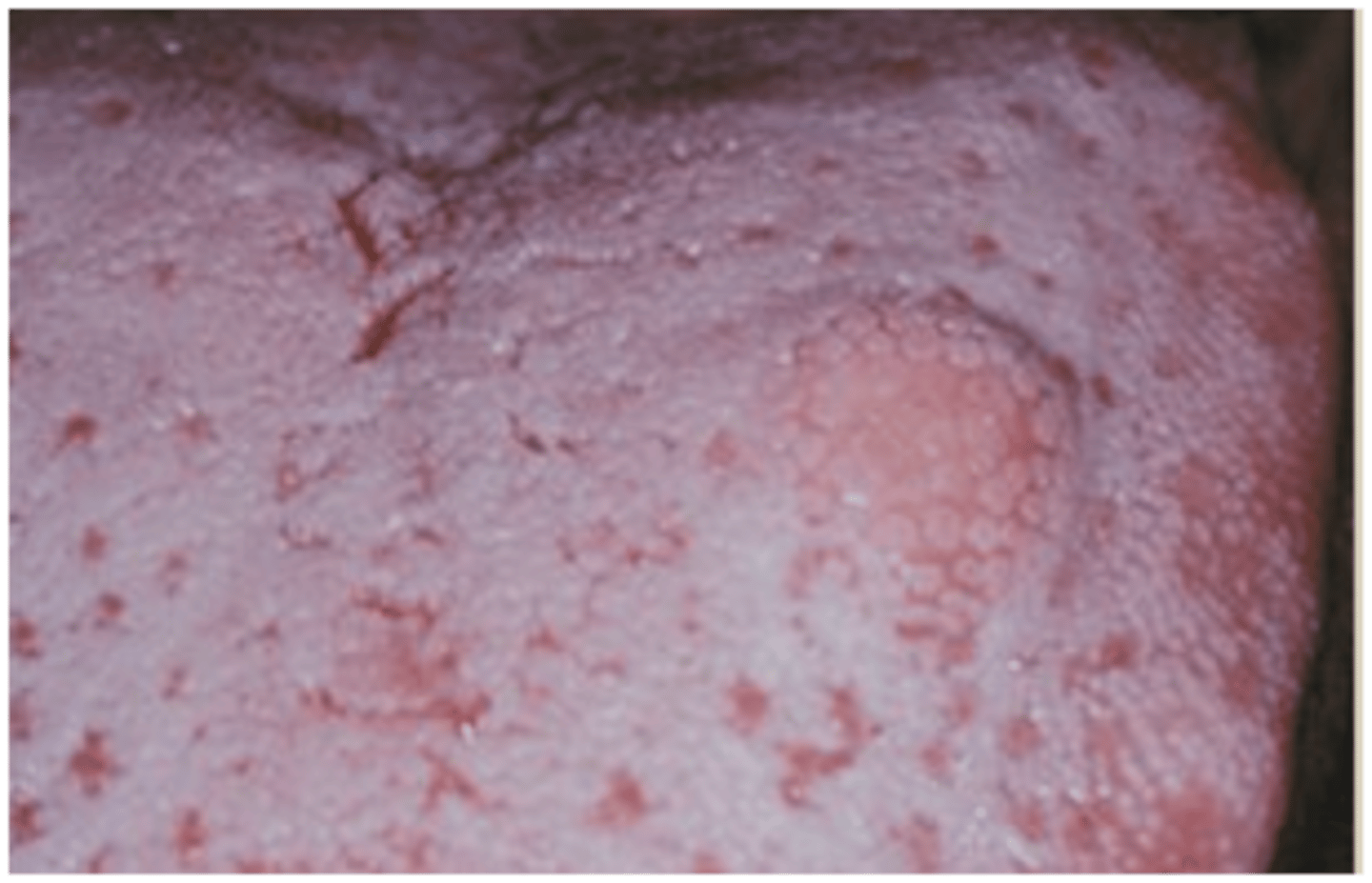 <p>• Most commonly found on the</p><p>dorsal tongue</p><p>• Asymptomatic sessile nodule</p><p>• Pink to yellowish in color</p>