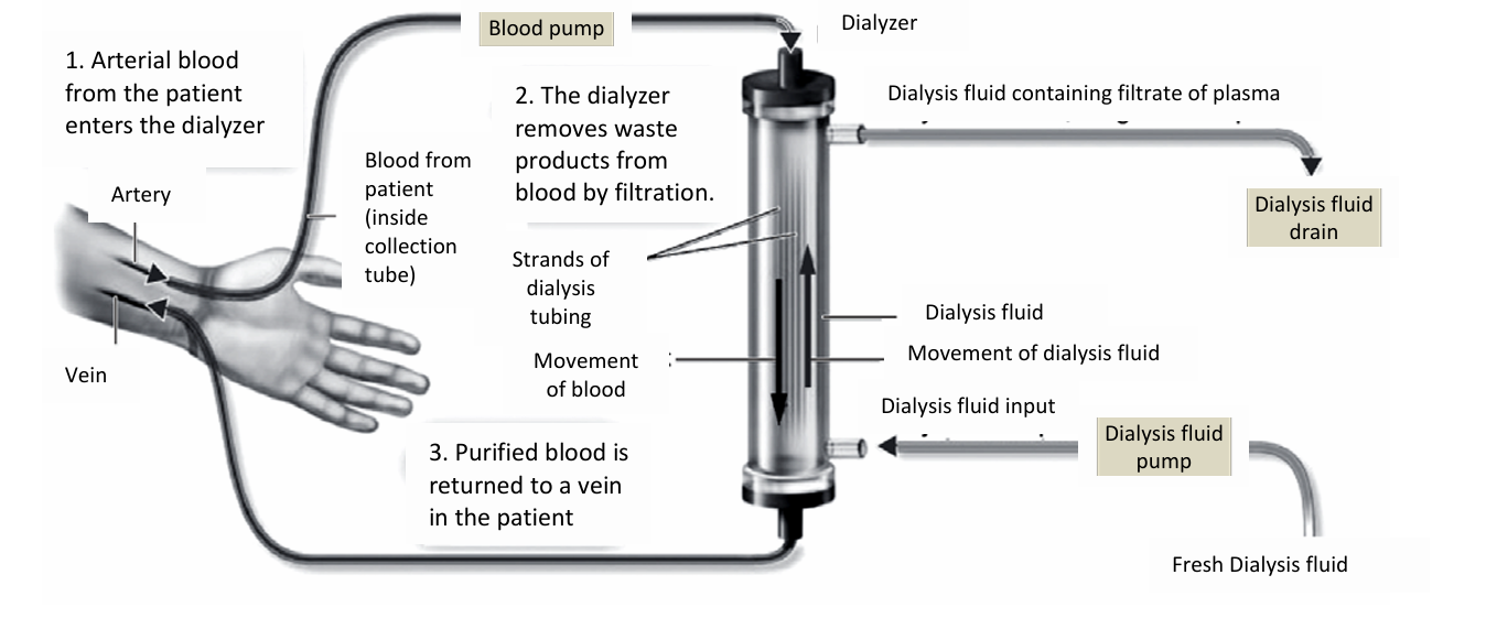 <p>using a dialysis machine to remove excess water, urea and ions from the plasma</p>
