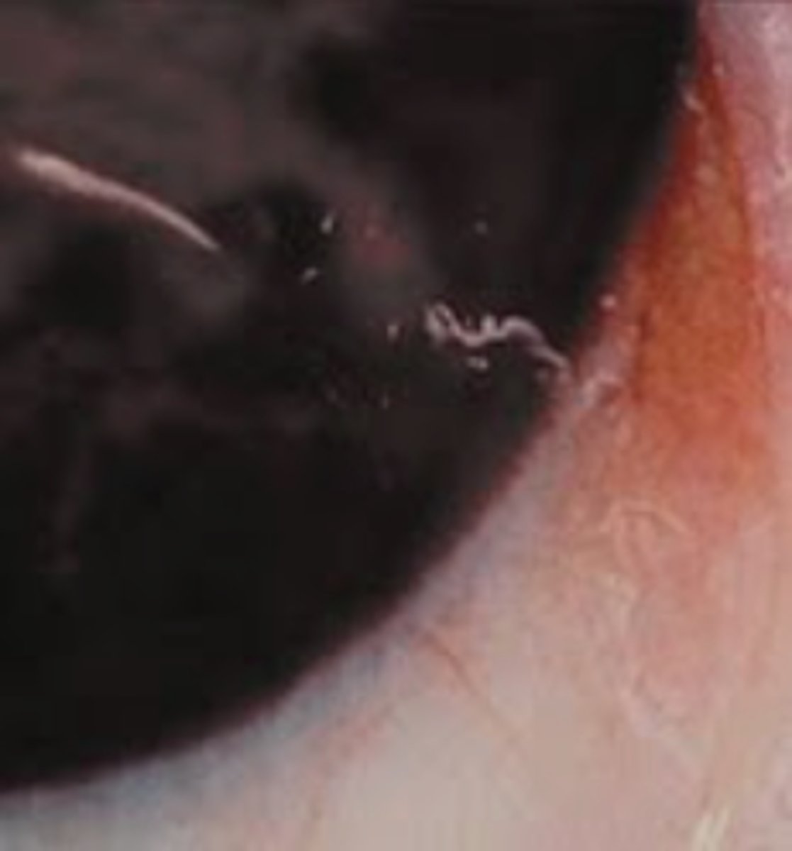 <p>-loa loa</p><p>-found in blood around 12pm!!</p><p>-DEER FLY *CHRYSOPS*</p><p>-</p>