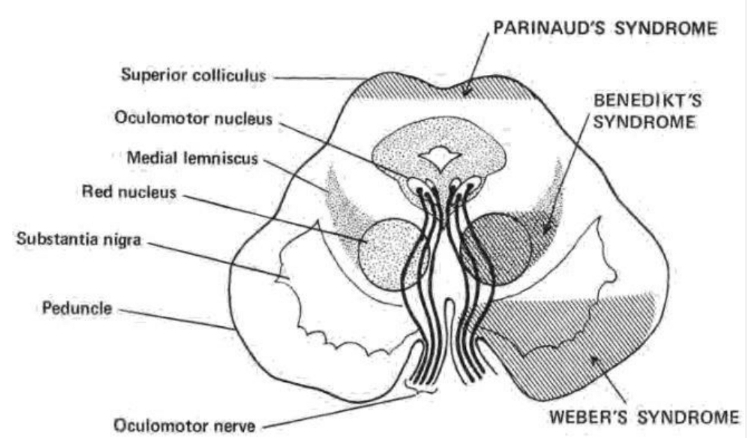 <p>Colliculus sup. seviyesinde crus cerebri’nin etkilenmesi sonucu meydana gelir </p>