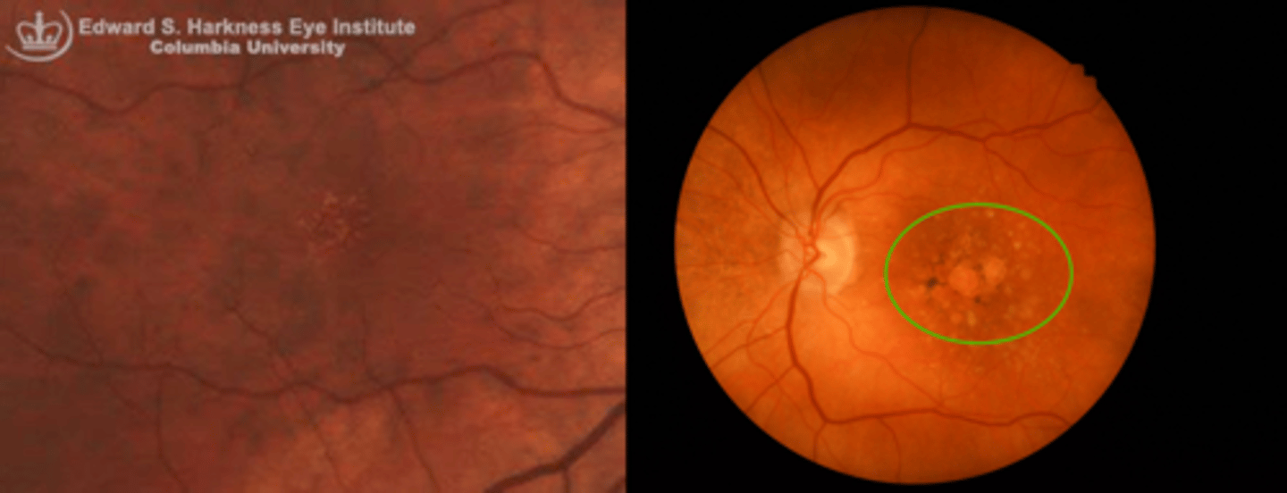 <p>numerous small (hard) or intermediate (soft) or large drusen in the macula</p><p>NOTE: often seen with geographic atrophy, RPE hyperplasia pigment</p>