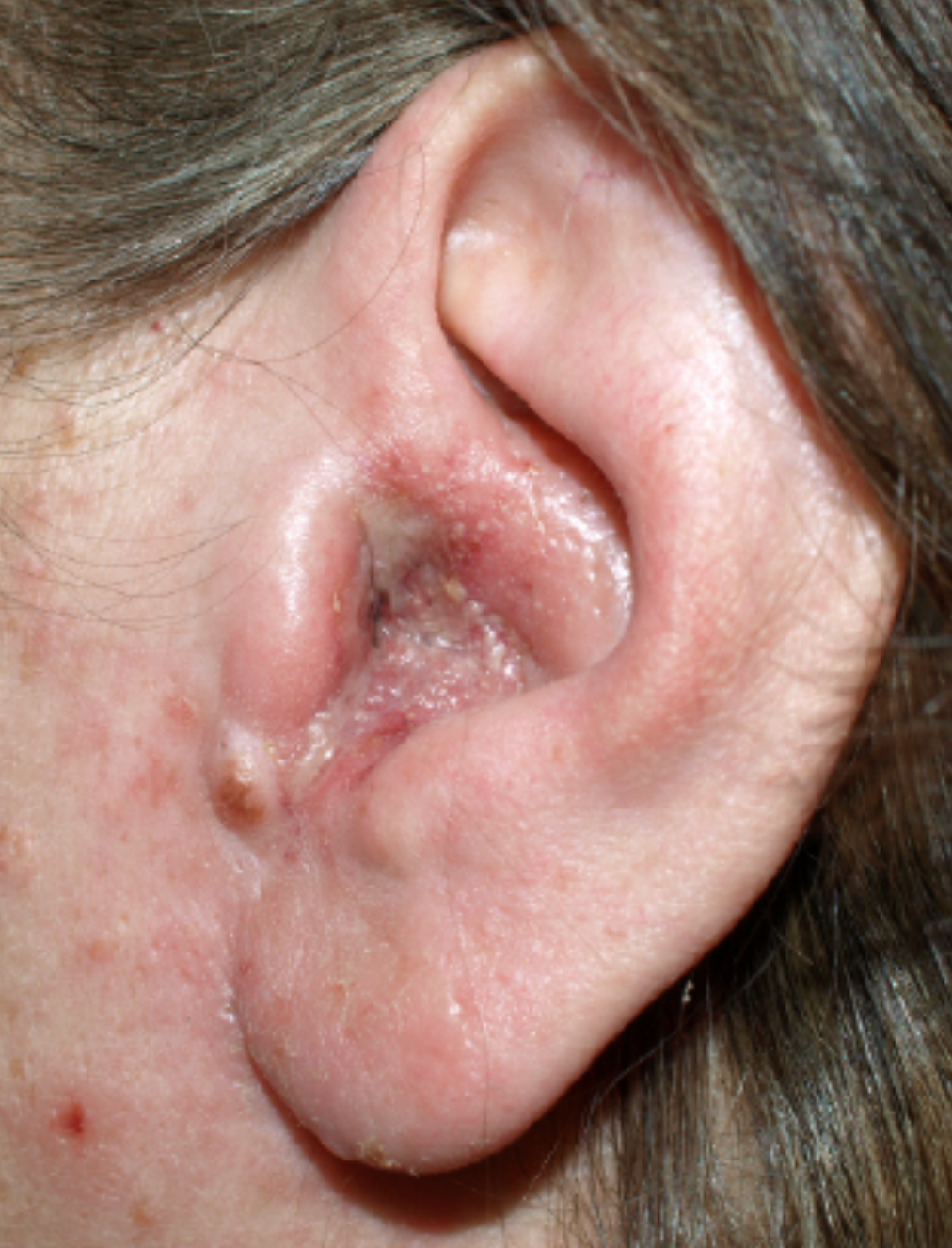 <p>Location: External Auditory Canal</p><ul><li><p>AKA ‘swimmer’s ear’</p><ul><li><p>Possible fever +/or drainage from external auditory canal </p></li><li><p>Likely pain</p></li><li><p>Swelling of pinna</p></li></ul></li></ul><p></p>