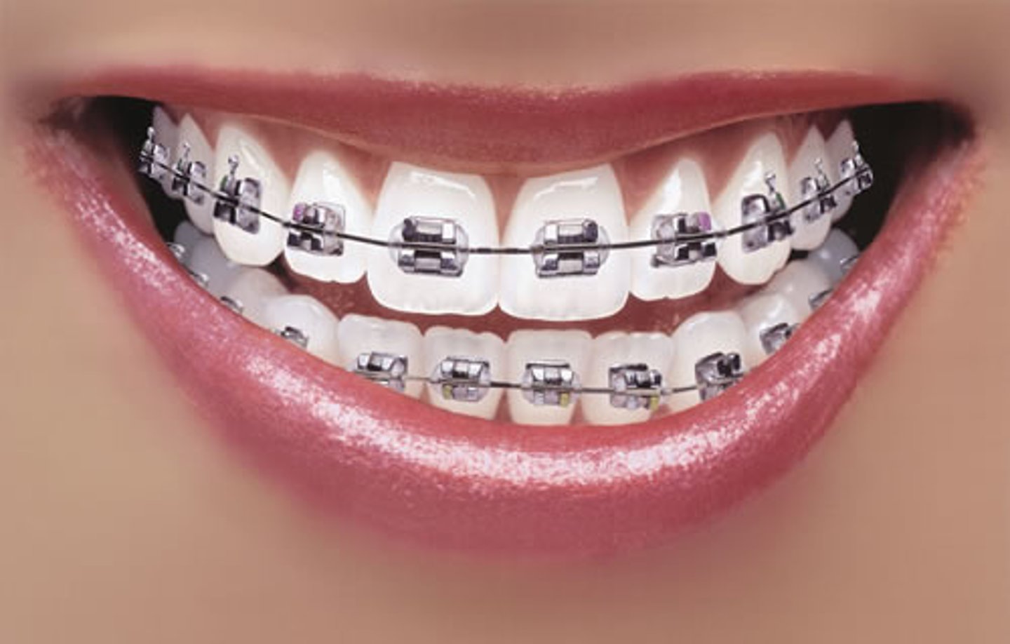 <p>braces</p>