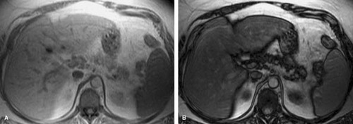 <p>infiltration of the tissue of an organ with excess amounts of fat</p>