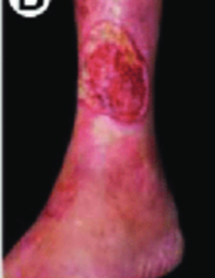 <ul><li><p>reduced blood supply </p></li><li><p>ischemia, necrosis </p></li><li><p>little exudate</p></li><li><p>atrophic skin</p></li><li><p>common in diabetes</p></li><li><p>pain</p></li></ul><p></p>