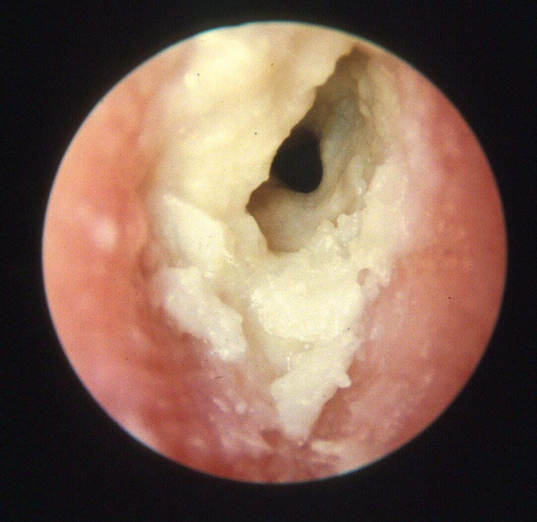 <p>Acute diffuse otitis externa</p><p>Most commonly due to bacterial or fungal infections after minor trauma to the ear</p>