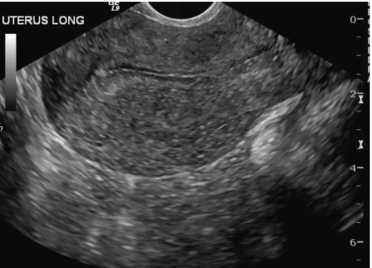 <p>Adenomyosis</p><p>-The ultrasound findings are subtle in this case but some features are present. They myometrium is mildly heterogeneous with small cystic areas and there is thickening specifically in the posterior uterus. These are all features of adenomyosis</p>