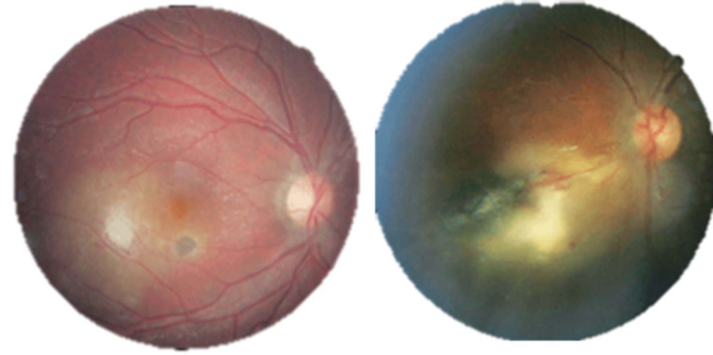 <p>+/- nearby retinal vasculitis</p><p>+/- secondary iridocyclitis</p><p>+/- papillitis, neuroretinitis, retrobulbar neuritis, scleritis, retinal detachment, punctate outer retinitis, branch retinal artery occlusion</p>