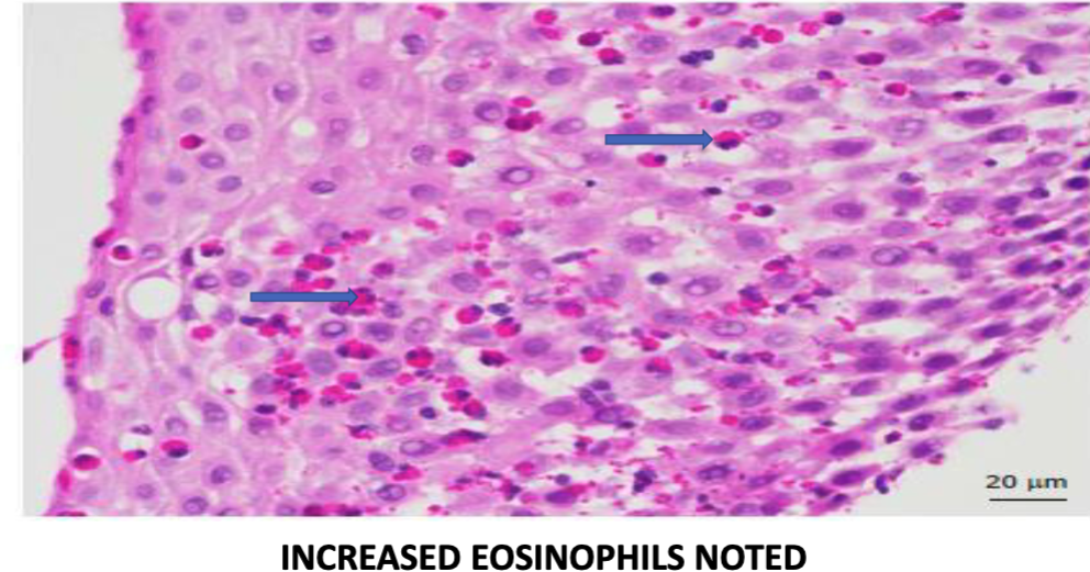 <p><strong>infiltration of eosinophils</strong> in <u>superficial aspect of lamina propria + epithelium</u>, distinguishing it from GERD or Crohn’s</p>
