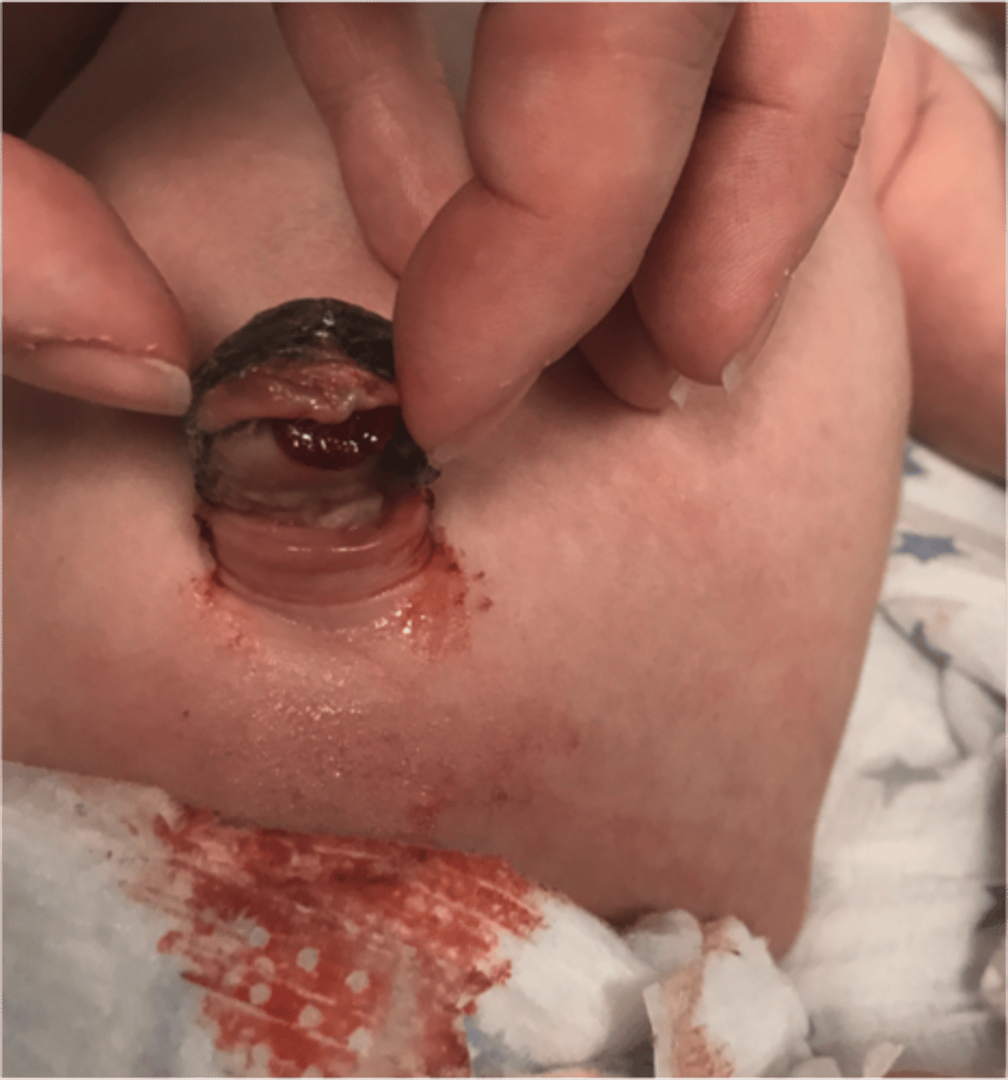 <p>Failure of this embryonic structure to close results in the ilium connecting to the umbilicus; herniation of the intestinal contents into the umbilical cord, mucoid/fecal discharge from the umbilicus (d/dx from umbilical hernia)</p>