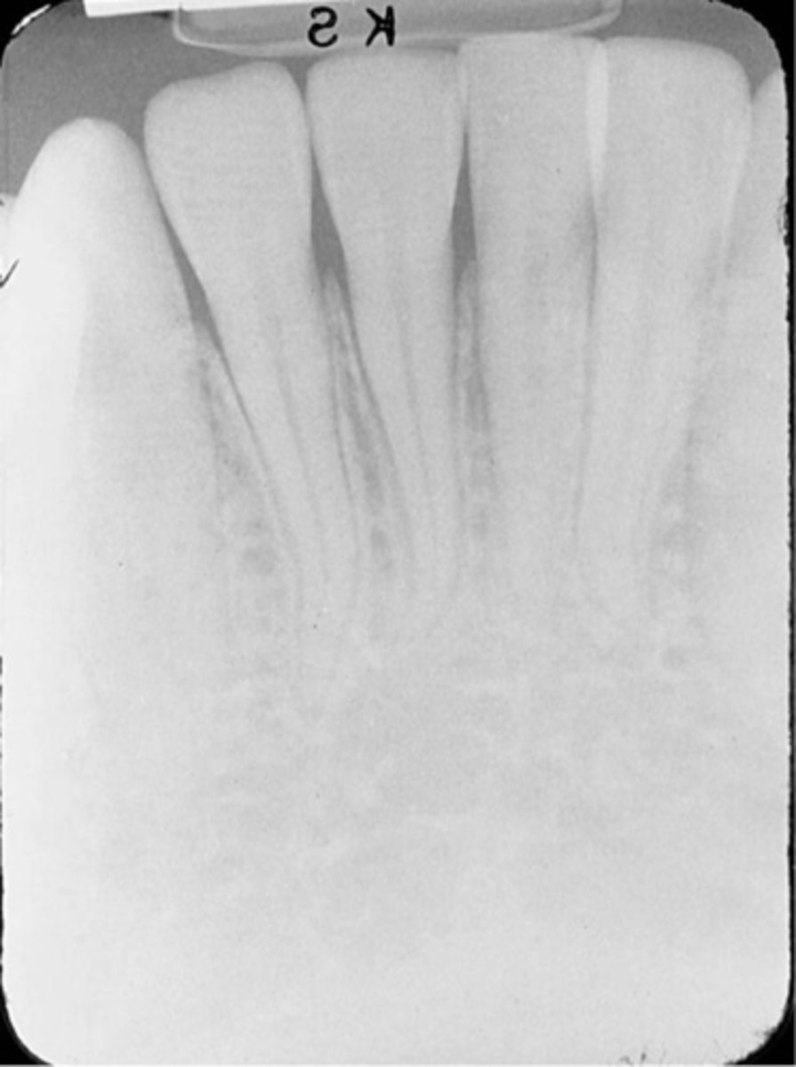 <p>-Image appears light</p><p>-Not exposed to enough radiation, resulting from kVp, mA, or a combination of these factors.</p><p>-To fix check exposure time, kVp, and mA settings on the machine before exposing; Increase exposure time, kVp, or mA</p>