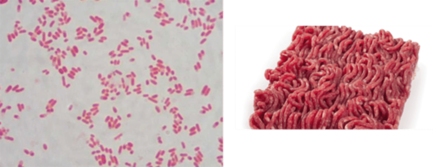 <p>Identify Pathogen causing Diarrhea:</p><p>Gram-negative rod (Shiga toxin-producing, aka STEC)</p><p>-Hx: </p><p>&gt; Undercooked beef or raw leafy veggies</p><p>&gt;&gt; Meat may become contaminated when organisms are accidentally mixed in, especially when it is ground</p><p>&gt; Drinking or Swimming water</p><p>&gt; Not washing hands (person to person)</p><p>-Path: Toxin causes Disease --&gt; Shiga-like toxin --&gt; Endothelium swells/vessel lumen narrows + Fibrin/platelets in microvasculature --&gt; Hemolysis + Inflammation</p><p>-Sx/PE: (1-8 days, usually 3-5 days)</p><p>&gt; Inflammatory/Bloody Diarrhea (Hemolytic Uremic Syndrome)</p><p>&gt;&gt; Microangiopathic Hemolytic Anemia (MHA)</p><p>&gt;&gt; Thrombocytopenia</p><p>&gt;&gt; AKI</p><p>&gt; FEVER &amp; SEPSIS</p><p>&gt; Abdominal Pain</p><p>-Dx:</p><p>&gt; Serotype: E. coli O157:H7</p><p>&gt; (+) Lactose</p><p>&gt; (+) Fecal Smear</p>