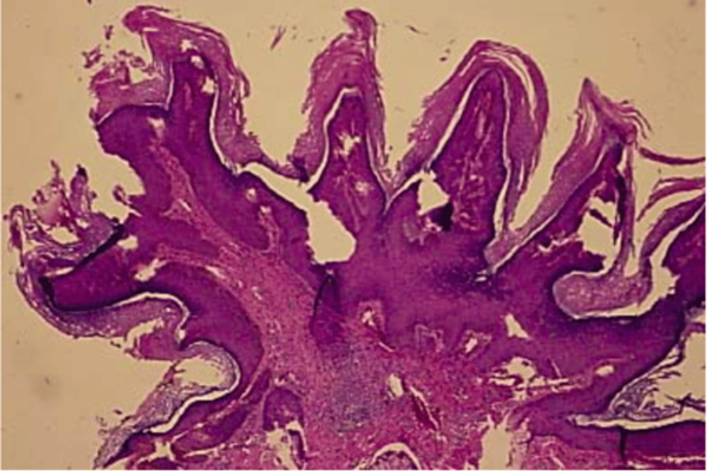 <p>histology of which benign epithelial lesion:</p><p>• Finger-like projections</p><p>• Fibrovascular cores</p><p>• Koilocytes (virally-altered</p><p>epithelial cells)</p>