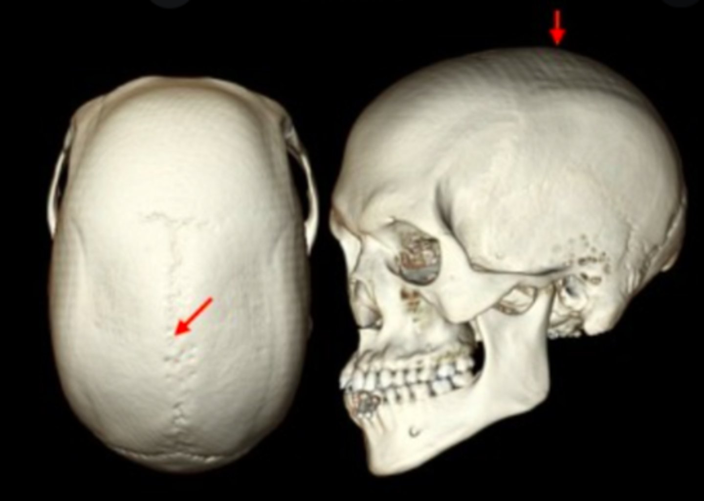 <p>superior point</p><p>found between parietal bones</p>
