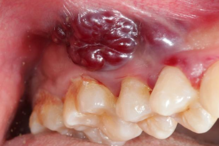 <p>What is the management of kaposi’s sarcoma?</p>