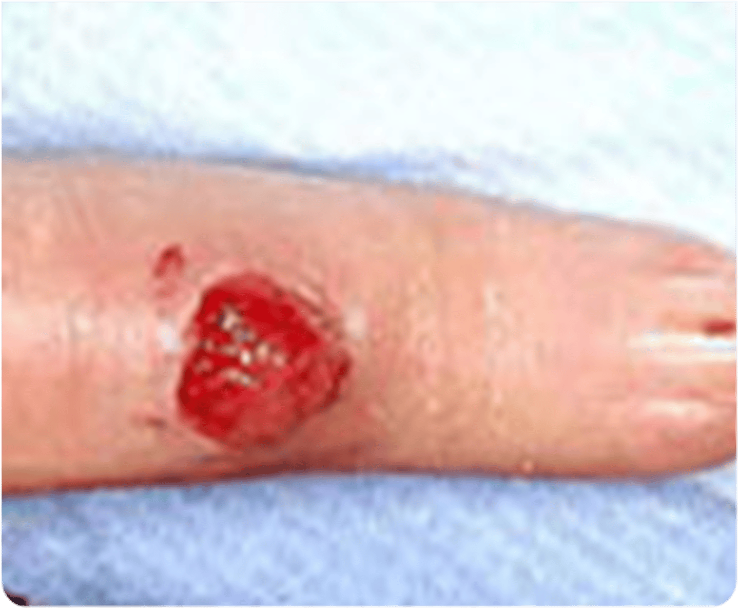 <p>_____________:</p><p>•Skin defect with loss of epidermis only</p><p>•Heals w/o a scar</p>