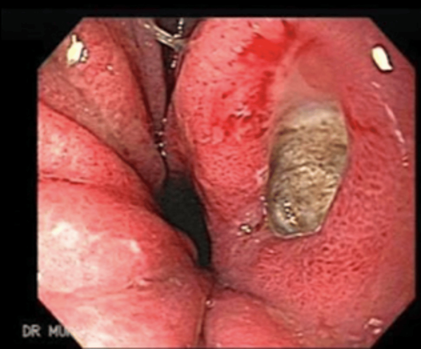<p>stomach endoscopy. what disorder do we see here?</p>