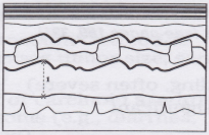 <p>in PLAX, perpendicular to Ao root and measured at level of the Ao sinuses from LE to LE</p>