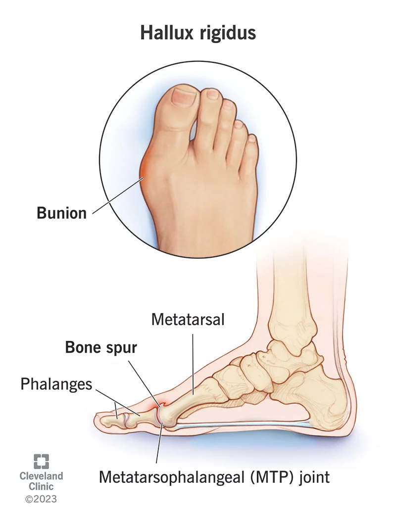 <p>Hallux</p>