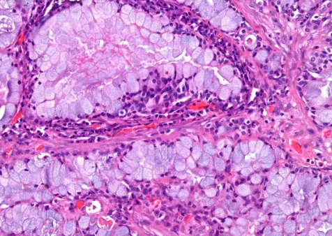 <p>Patient avec tumeur de la parotide </p><p>1) Diagnostic</p><p>2) Epidémiologie et localisation</p><p>3) Histologie</p><p>4) IHC</p><p>5) moléculaire</p>