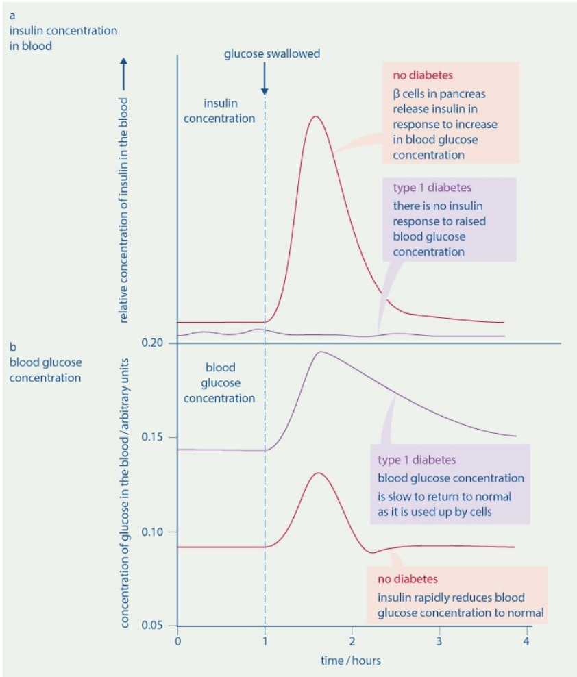<p>Insulin concentration in blood</p><ul><li><p>No diabetes: Beta cells in pancreas release insulin in response to increase in blood glucose concentration</p></li><li><p>Type 1 diabetes: No insulin response to raised blood glucose concentration</p></li></ul><p></p><p>Blood glucose concentration</p><ul><li><p>Type 1 diabetes: blood glucose concentration is slow to return to normal as it is used up by cells</p></li><li><p>No diabetes: Insulin rapidly reduced blood glucose concentration to normal</p></li></ul><p></p>