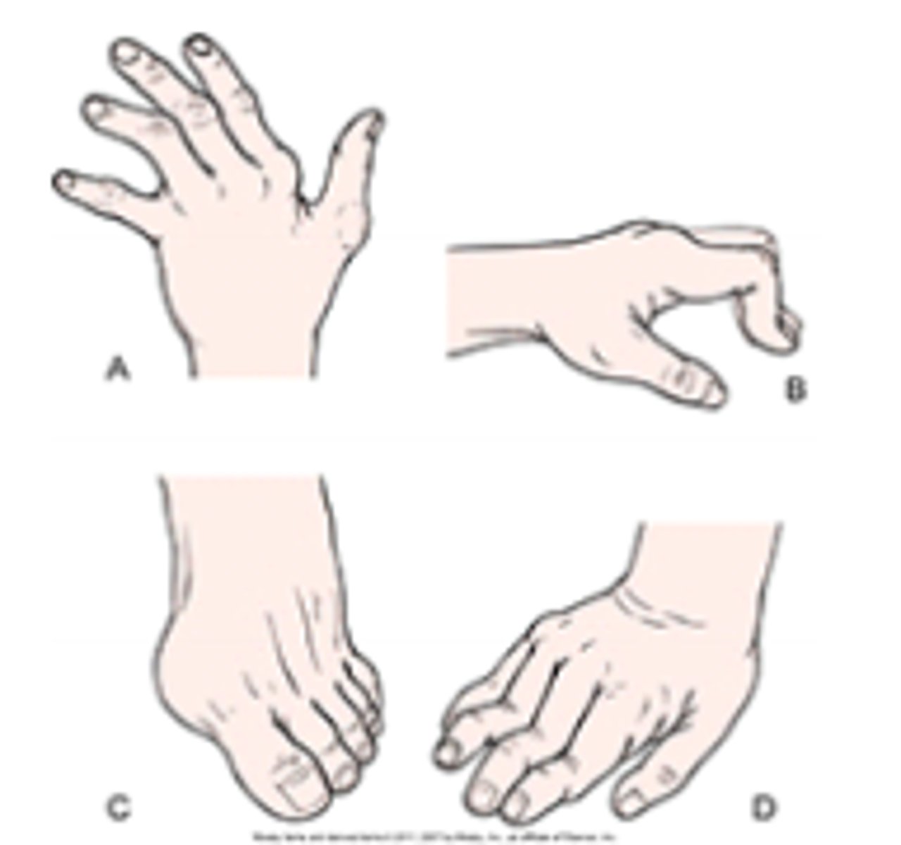 <p>When reviewing the health record for a new patient with rheumatoid arthritis, the nurse reads</p><p>that the patient has swan neck deformities. Which deformity will the nurse expect to observe</p><p>when assessing the patient?</p><p>a. A</p><p>b. B</p><p>c. C</p><p>d. D</p>