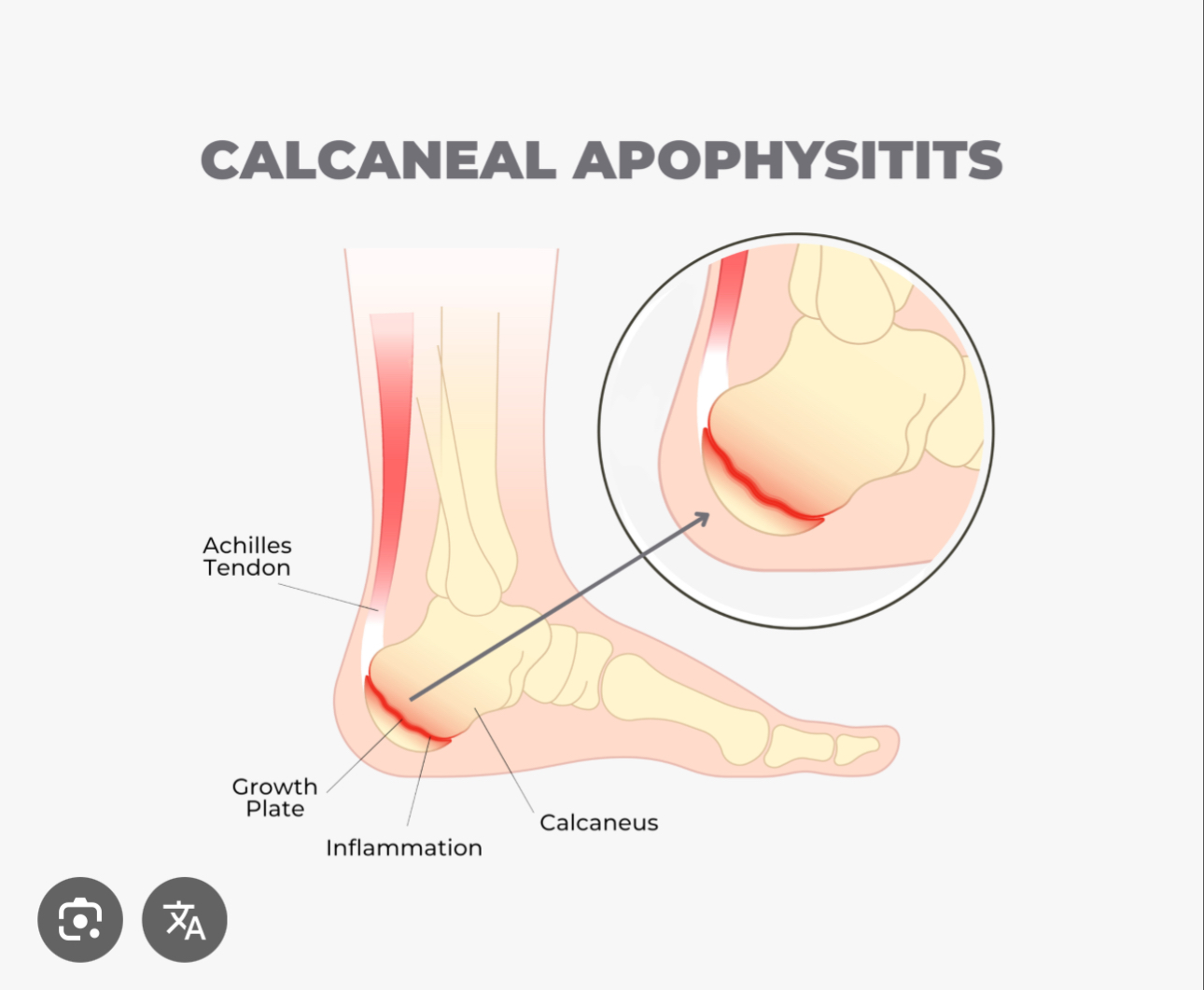 <p>Strong bone in the heel of the foot</p>