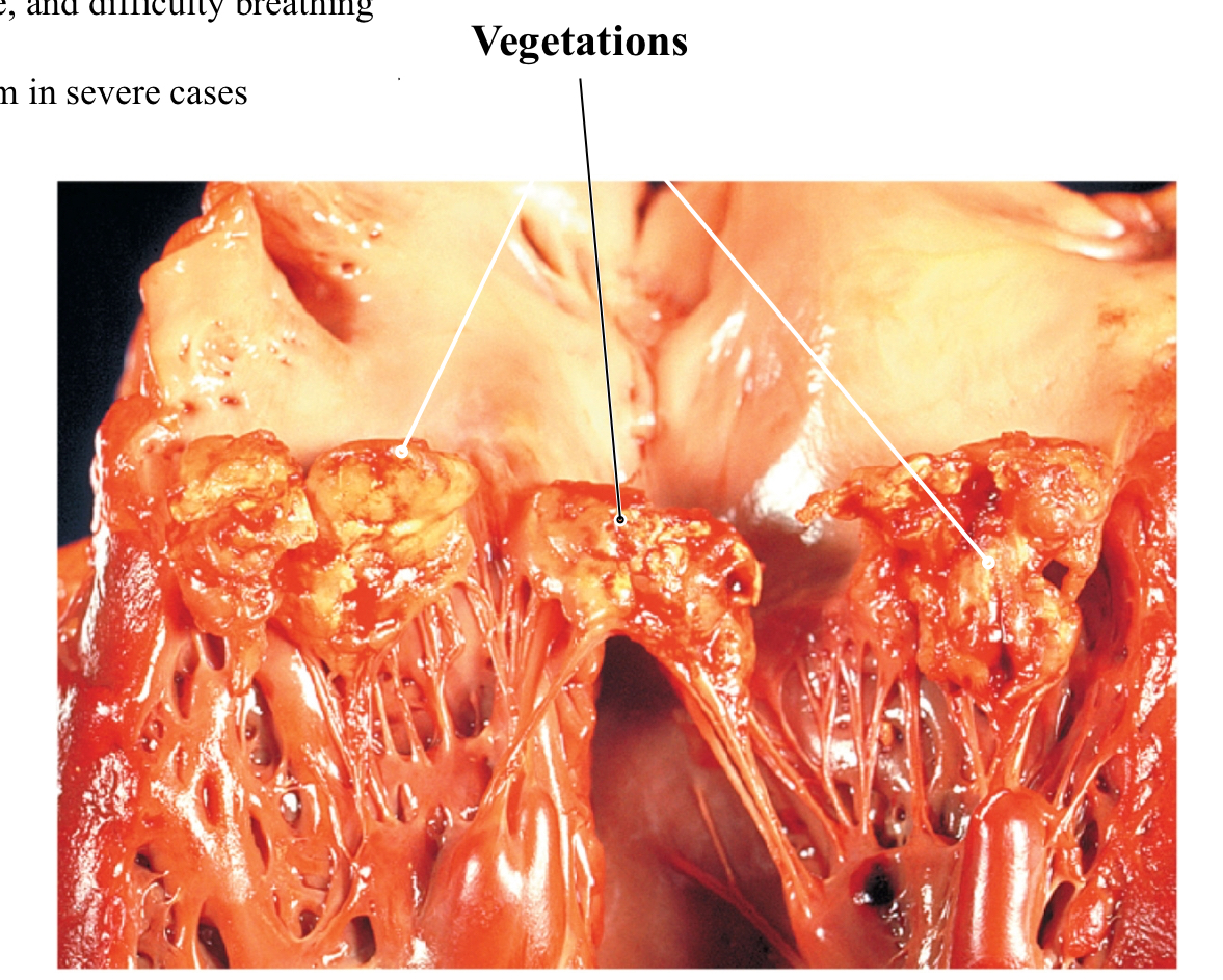 <p><span style="background-color: transparent;"><span>Endocardium lines the heart chambers, valves, and vessels near the heart</span></span></p><p><span><span>-Bacteria along the linings trigger inflammation and the formation of vegetations</span></span></p><p><span style="background-color: transparent;"><span>Vegetations- bulky masses of platelets and clotting proteins that surround the bacteria</span></span></p><p>Complications: <span style="background-color: transparent;"><span>IV drug use; Heart abnormalities; Suppressed immune system; </span></span></p><p><span style="background-color: transparent;"><span>Increases risk for strokes as the vegetation can break off ( interrupt blood flow through brain)</span></span></p>