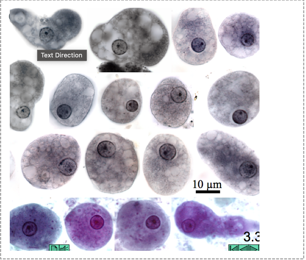 <p>Name: Entamoeba coli</p><p class="p1">Stage: trophozoite</p><p class="p1">*Endosome off-center</p><p class="p1">*Chunky, uneven ring around nucleus</p>