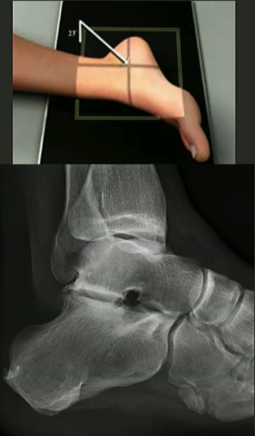 <ul><li><p>externally rotate from lateral position by supporting heel.</p></li><li><p>CR angled 5 degrees anterior and 25 degrees caudal.</p><ul><li><p>Used to visualise changes in pes planus and/or hindfoot valgus.</p></li></ul></li></ul><p></p>