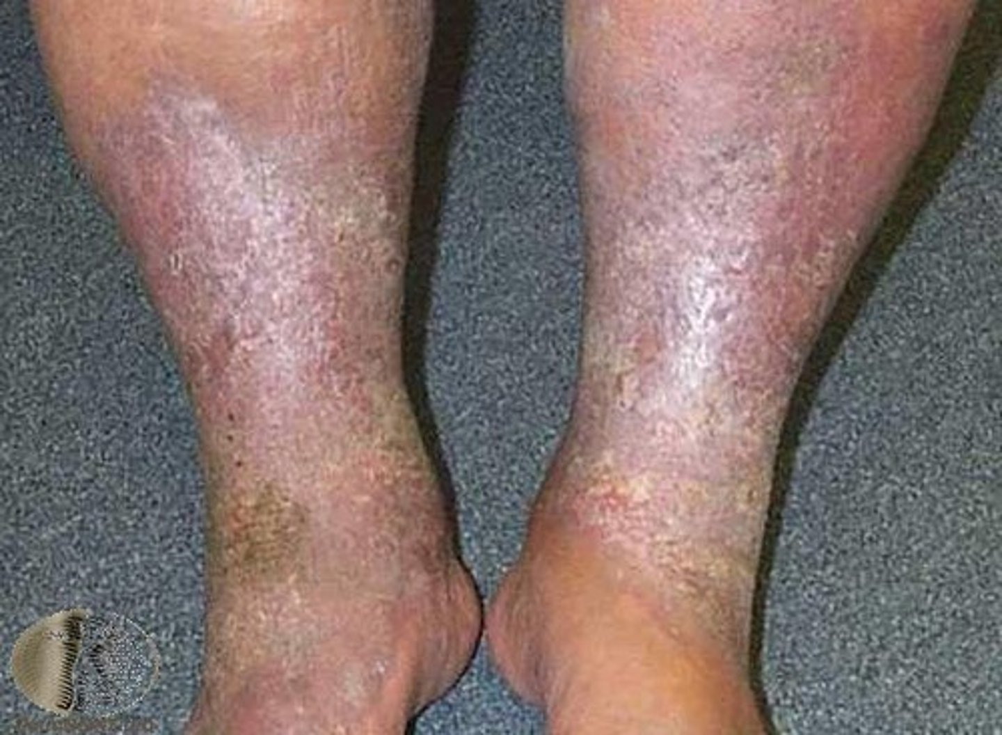 <p>diagnose this image:</p><p>this has swelling, color change, itch, weeping and crusts</p>
