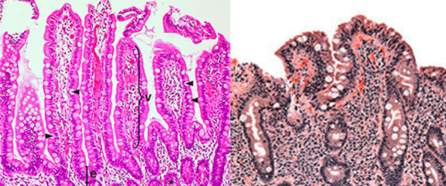 <ul><li><p><span>a disorder of the small intestine.</span></p></li><li><p><span>Gluten reacts with the lining of the small intestine, leading to an attack by the immune system and damage to the microvilli and villi</span></p></li><li><p><span>Histologic features include villous atrophy and inflammatory cells</span></p></li></ul><p></p>