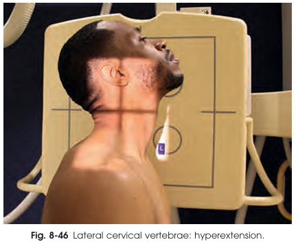 <ul><li><p>Patient tilts head backward, elevating chin as much as possible</p></li><li><p>Spinous processes appear depressed and closely approximated</p></li></ul><p></p>