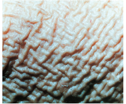 <p>seborrheic keratosis</p>
