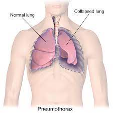 <p><span>Occurs when air leaks into the space between the lung and chest wall, causing the lung to collapse.</span></p>