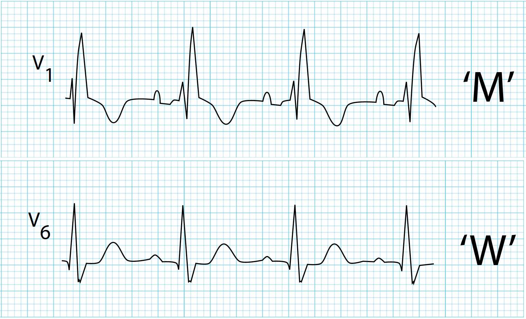 <p>QRS complex starts like an M and moves towards being more like a W.</p>